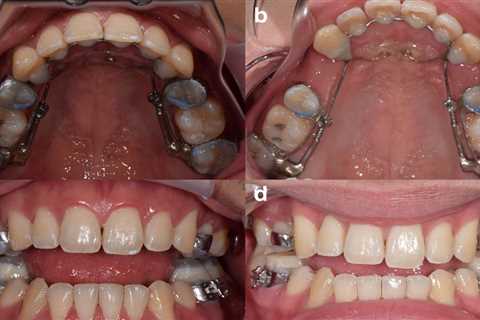 Este dispositivo dental debía arreglar las mandíbulas de los pacientes. Las demandas afirman que..
